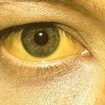 Penyebab-Penyakit-Kuning